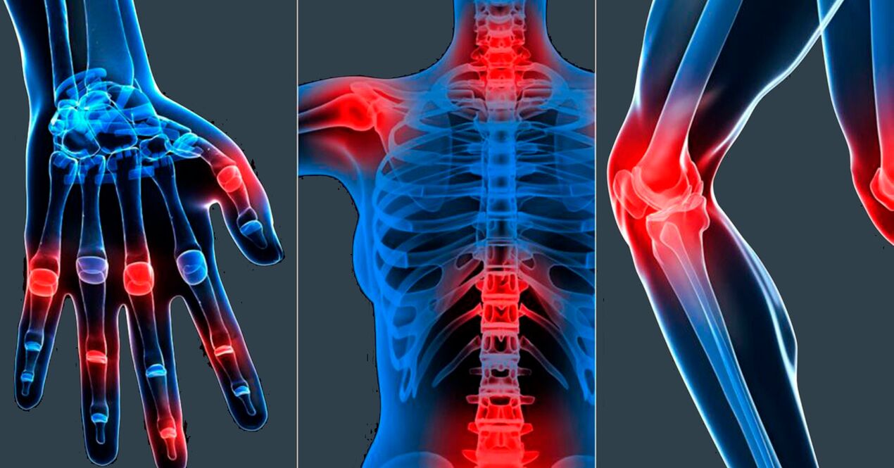 Indikace pro použití extraktu Boswellia v kapslích